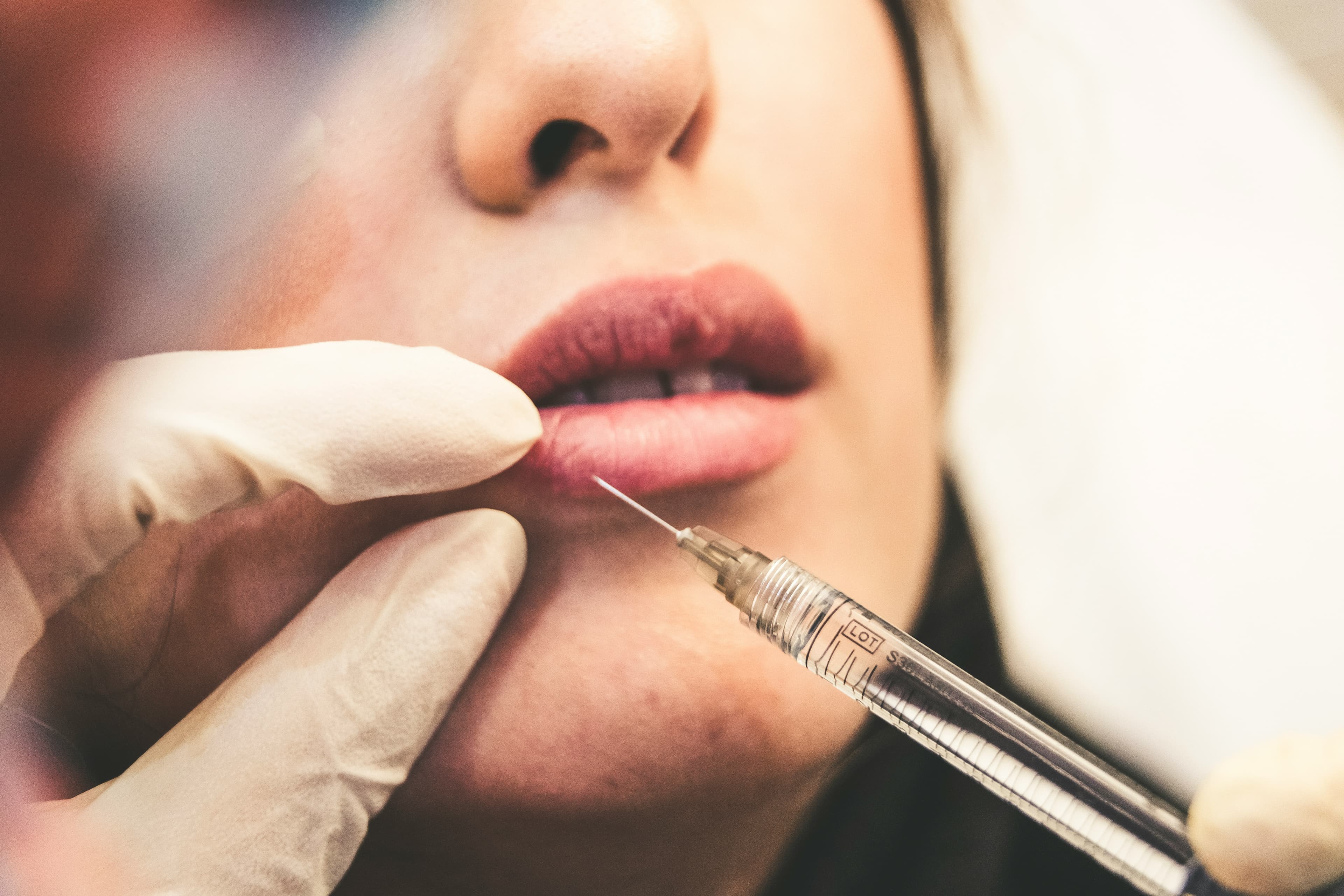 Aplicação delicada de preenchimento labial