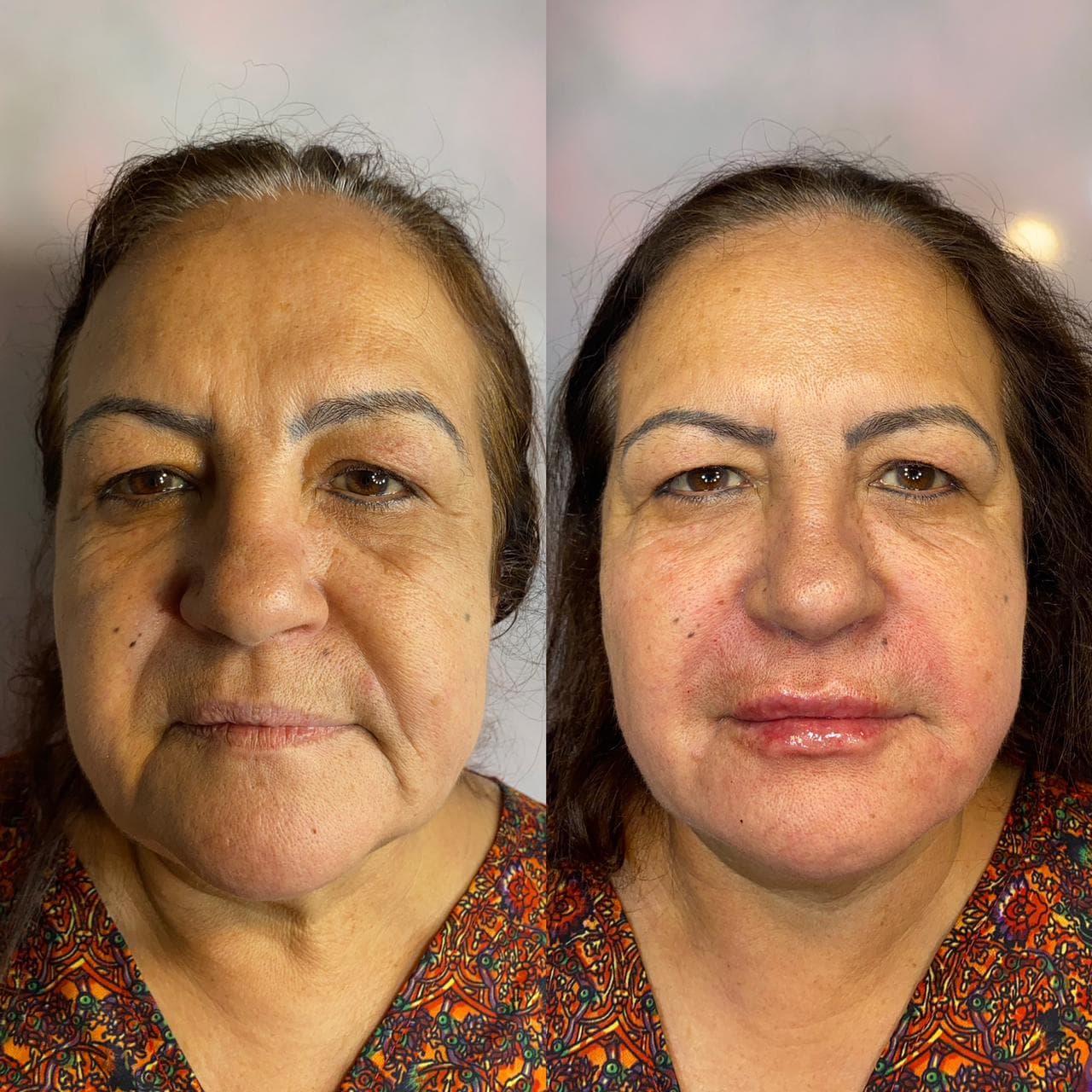 Antes e depois de tratamento de rejuvenescimento facial, vista frontal