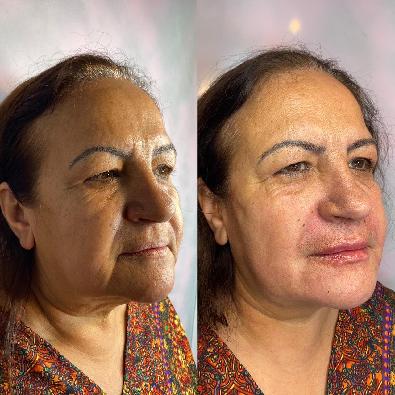 Antes e depois de harmonização facial, vista em perfil