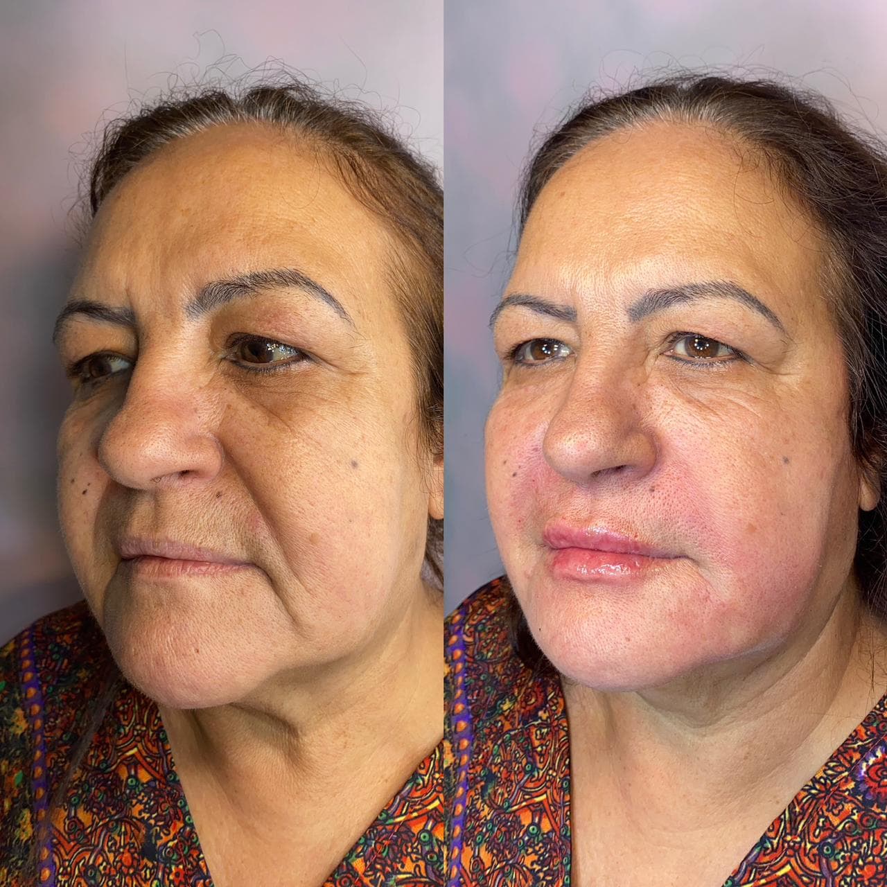 Resultado de Preenchedores — Dra. Daniele Monteagudo